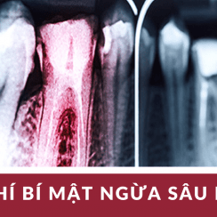 G43, sâu răng, đau răng, nhức răng, cách chữa đau răng, cách trị nhức răng